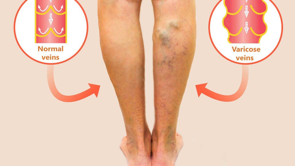 varicose-veins-thegem-blog-default